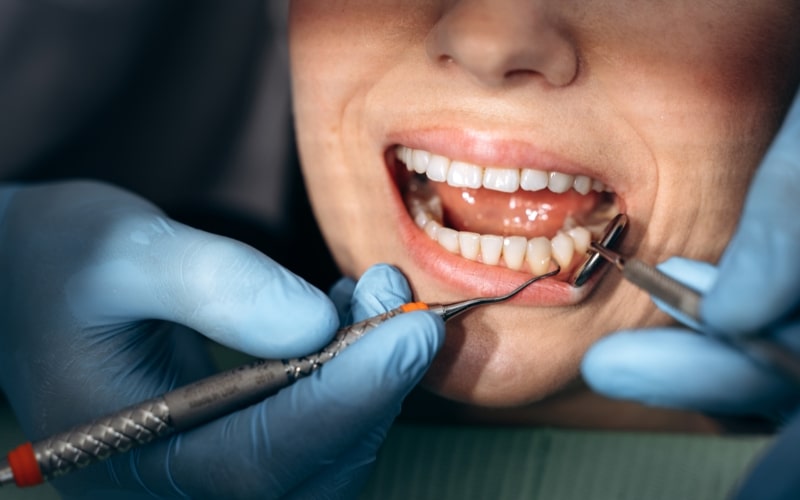Causes of Periodontal Disease
