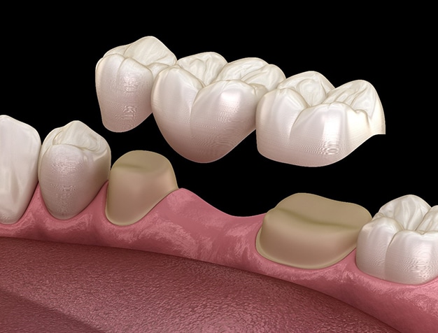 Dental Bridges in Ventura, CA - The Smile Shapers
