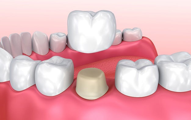 Dental Crowns in Ventura, CA - The Smile Shapers