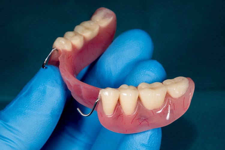 Partial Dentures in Ventura, CA - The Smile Shapers
