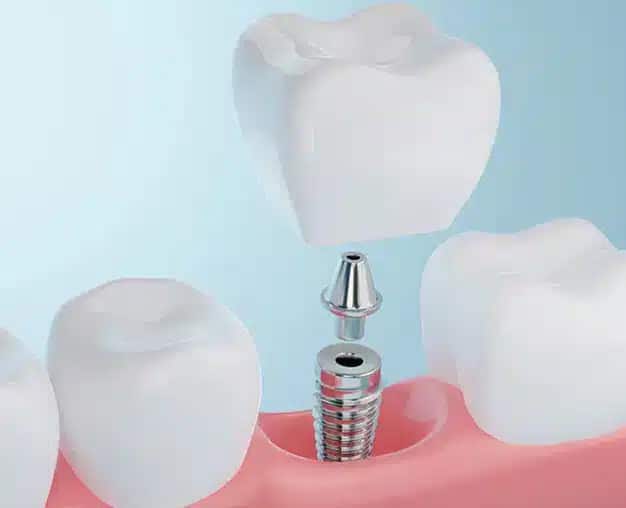 Dental-Implants-Ventura
