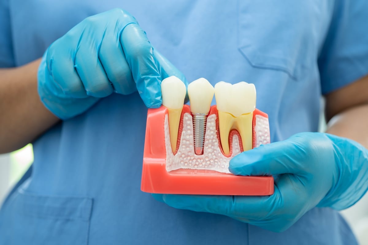 dental-implants-in-Ventura